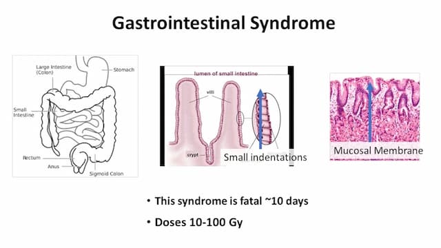 Medical infographic on Acute Radiation Poisoning showing gastrointestinal syndrome, intestinal mucosal damage, villi structure, fatal course within 10 days at radiation doses 10–100 Gy — emergency clinician reference guide