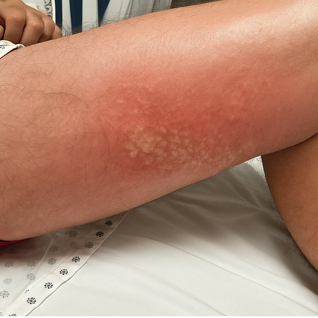 Skin irritation and erythematous rash on the upper inner thigh of an adult male patient, possibly indicative of contact dermatitis or fungal infection, commonly assessed in dermatotoxicology.