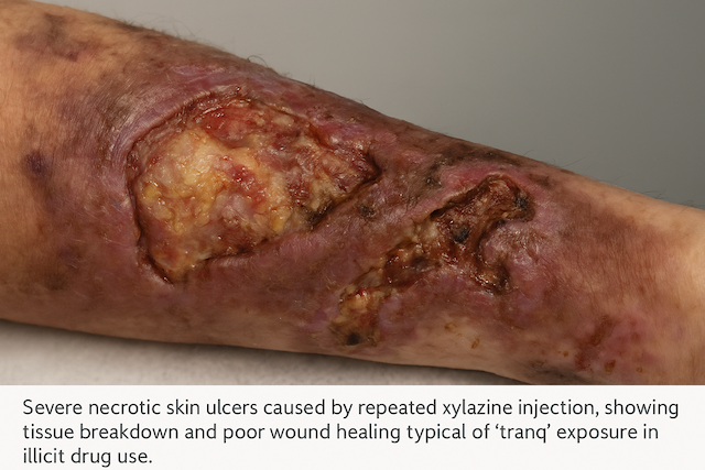 Severe necrotic skin ulcers caused by repeated xylazine injection, showing tissue breakdown and poor wound healing typical of 'tranq' exposure in illicit drug use