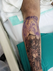 Incomplete lion tattoo on patient’s leg during hospitalization after opioid overdose at tattoo parlor — medical case highlighting risks of unlicensed opioid use for tattoo pain relief leading to hypoxic encephalopathy and vegetative state
