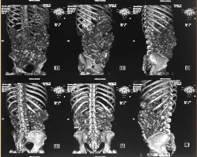 CT scan image of a suspected body packer, showing multiple drug-filled packets within the gastrointestinal tract. Used for medical diagnosis and forensic analysis of concealed drug trafficking.